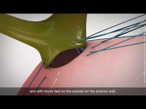 Roux-en-Y hepaticojejunostomy technique