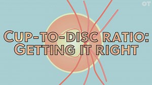 Cup to disc ratio: getting it right