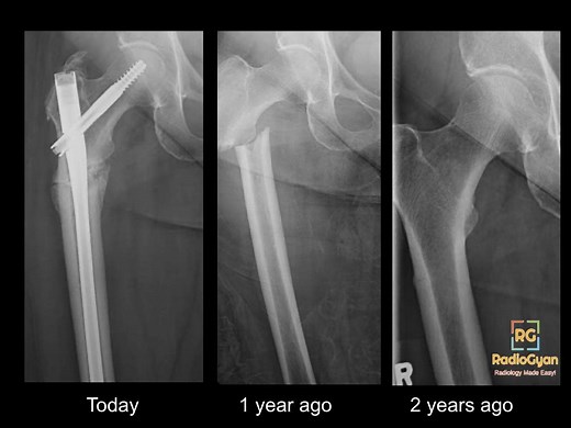 Atypical Femoral Fracture - What Radiologsits Need to Know!