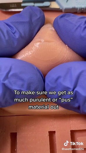 Close-up Abcess Drainage - Massive Pimple Pop