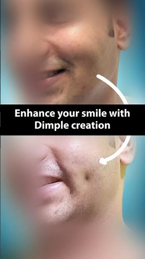 Enhance Your Smile 😁 with Dimple Creation! Before and After Dimpleplasty #shortsviral