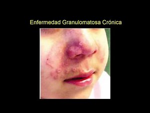 Enfermedad Granulomatosa Crónica (Apuntes)