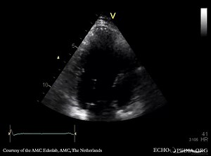 File:Apical infarction E00530 (CardioNetworks ECHOpedia).webm - Wikimedia Commons