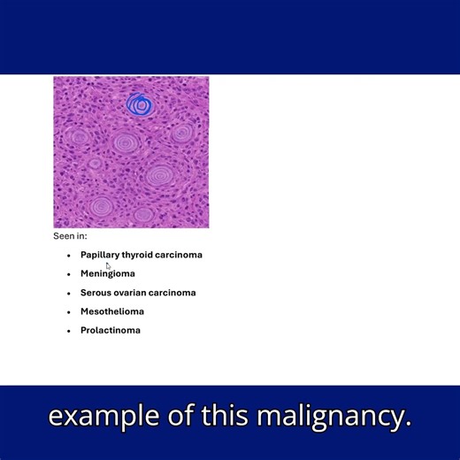 Psammoma Bodies #medicaleducation #cellinjury #pathology #cellinjurypathology #usmle