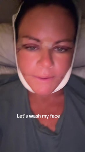 3 days post op from upper bleph, lower face and neck lift. | face