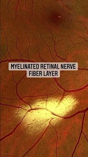 Myelinated Retinal Nerve Fiber Layer #retina #oftalmo #ophthalmology #oftalmologia #oftalmología #o