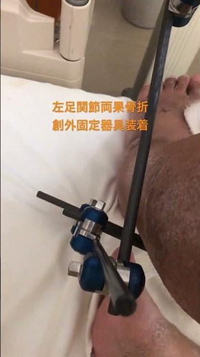 左足関節両果骨折(創外固定)