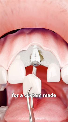 Tooth Implants Using Hip Bone 🤔 | Zack D. Films