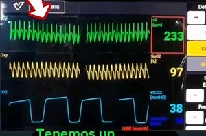 EKG Insights on Instagram: "變 Monitor Case - guess the rhythm . A patient shows this rhythm, what does It suggests? . #ecg #ecginterpretation #ecgchallenge #ecgfindings #ekg #cardiologist #rhythm #nurse #cardiologistaintervencionista #ecglovers #pvc #flutter #tachycardia #arrhythmia #monitor #cardio #sinus #vtach #fv #torsades"
