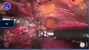 Robotic Subxiphoid Thymectomy