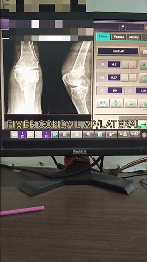 fimer condail fractur #anatomy