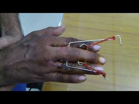 Dynamic External fixation using a Suzuki frame