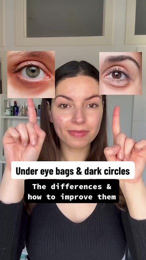 Under Eye Bags vs Dark Circles: Understanding the Differences and Solutions