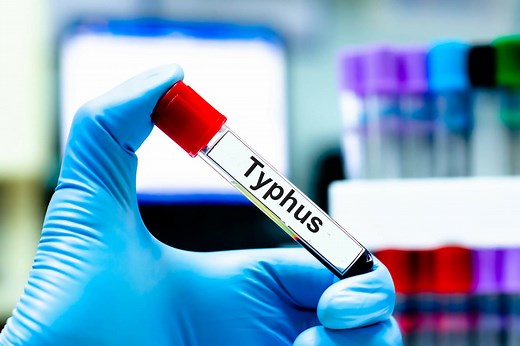 Typhus : causes, symptômes, c'est quoi ?
