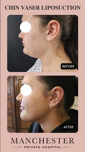 Incredible Chin Vaser Liposuction Results | Chin Vaser Liposuction Manchester