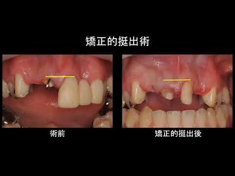 矯正的挺出術＆歯冠長延長術解説動画 210310001 #エクストルージョン#歯冠長延長術#MTM