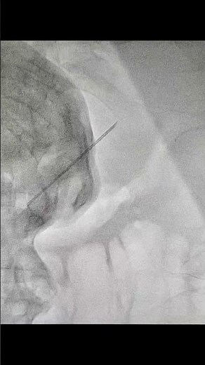 Fluoroscopy guided pericardiocentesis.