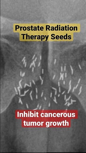 Prostate Radiation Therapy Seeds on X-Ray #xray #prostate #radiation