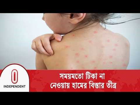সারাদেশেই হঠাৎ বেড়েছে হামের প্রাদুর্ভাবে ৫১ শিশুর মৃ/ত্যু | Child Health | Independent TV