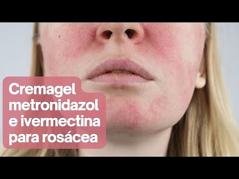 Cremagel con metronidazol e ivermectina para el tratamiento de la rosácea