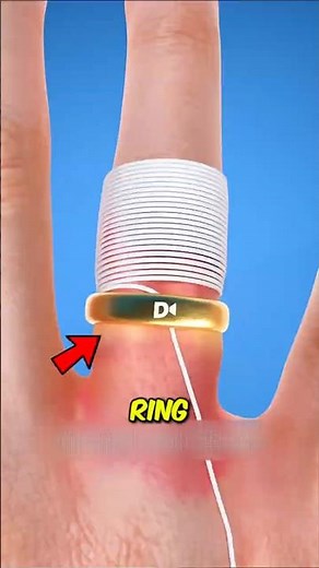 Why a Stuck Ring Can Be More Dangerous Than You Think