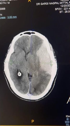 Meningioma on Brain CT | Key Imaging Signs #shorts