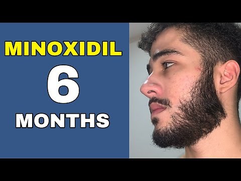 Minoxidil Beard Journey 6 MONTHS TRANSFORMATION