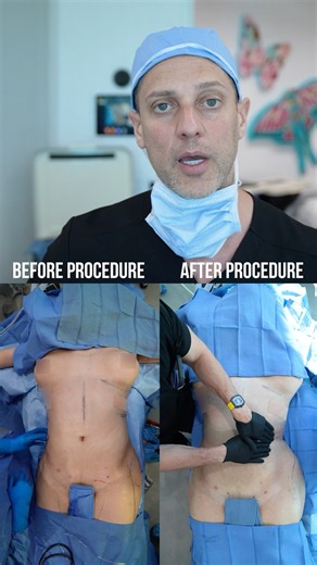 Rib Remodeling Surgery Before & After #ribremodeling #genderaffirmingsurgery #lipo #bbl #ribxcar