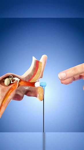 Earbud Stuck in Ear for 5 Years: A Shocking Discovery