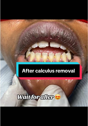 Teeth Cleaning Process Explained After Calculus Removal