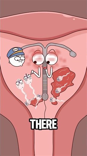 How does an IUD work?#shorts#funny #hot