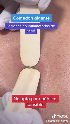 Tratamiento de Comedones Gigantes con Pimple Popper