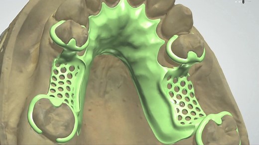 3shape 数位化设计钢托全过程。\n