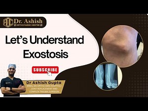 🦴 Let’s understand Exostosis!
