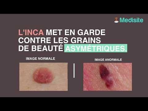 Ces 4 grains de beauté peuvent trahir un cancer cutané