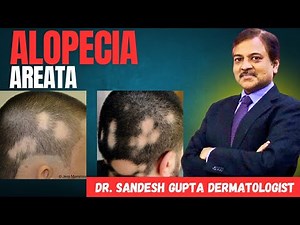Alopecia Areata Explained: Causes, Symptoms & Treatment | #skincare #haircare #viralvideo #trending