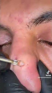 Black heads #deepcleansing #blackheads #skincaretips #satisfying