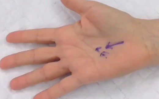 扳机指（trigger finger）