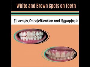 White Spots on Teeth!! Decalcification, Fluorosis and Hypoplasia