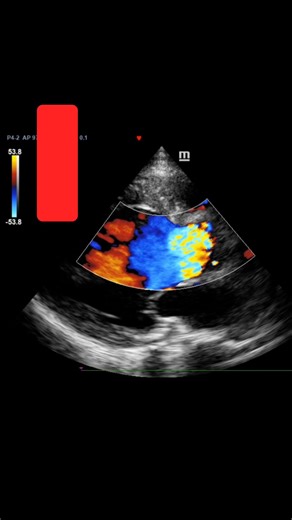 3 Part of Aortic Regurgitation Jets on Echo ⬇️ 1. Jet area 2. Vena contracta (VC) 3. Flow convergence Chronic AR imposes a volume load on the left ventricle. To compensate, the ventricle often becomes hyperdynamic (ejection fraction >70%) in earlier stages. Over time, persistent volume overload can lead to ventricular dilation, declining systolic function, and eventual heart failure. 👉 Weekly echocardiography lessons backed by research and built for real clinical impact. Join thousands of echo 