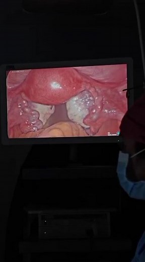 "Tubal chromopertubation To check if the fallopian tubes are open or not."