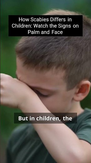 Uncover the Hidden Signs of Scabies in Children!