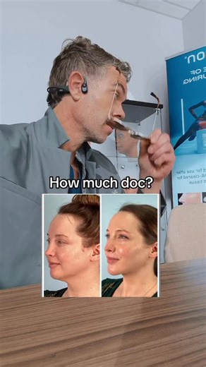 Dr. Benjamin Caughlin MD, FACS on Instagram: "It’s Tailor made to your jawline. So Really depends on a few things. Your goals and your anatomy such as Fat content, bone structure vs. skin laxity. If I can get away with just jawline sculpting maybe some structure ends up more like 12k-18k. That is mostly my goal. Sometimes if it’s mostly skin, due to things such as weight loss, age or skin damage then, that is more like and ends up being a mini neck lift (sneaky lyft) of sorts which currently is 