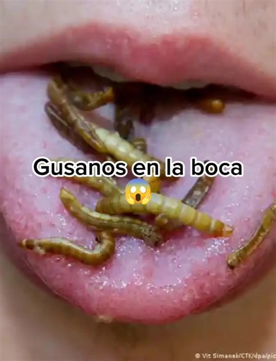 La miasis oral , aunque POCO FRECUENTE . Puede deber su aparición cuando las condiciones bucales y el ambiente se juntan para crear el ambiente ideal para que las moscas puedan causar estragos. La prevención y los buenos hábitos de higiene es la clave del exito para prevenirla. #limpiezadentalprofunda #odontologia #manabi_ecuador #manta #odontologo #miasisoral #miasis