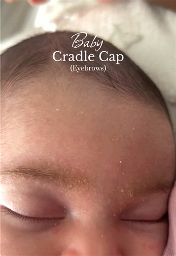 Effective Cradle Cap Removal for Newborns