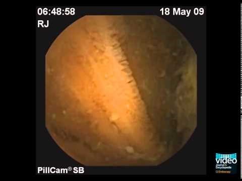 Small Bowel Tumor Detection in Capsule Endoscopy