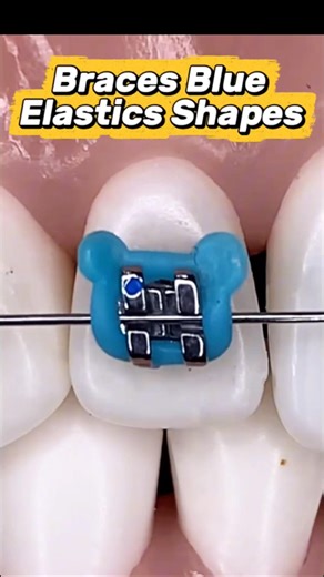 So satisfying! ✨ Braces Blue Elastics Shapes #orthodontist #braces #dentist