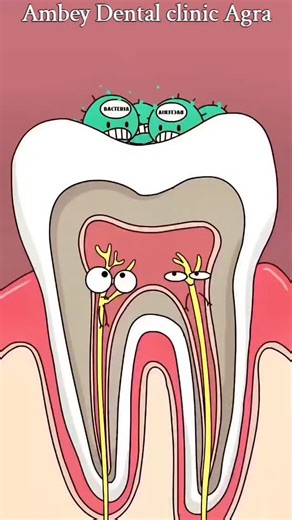 Dental & facial aesthetic centre on Instagram: "Brutal Toothache Explained: What Is Pulpitis and Why It Hurt . . . . . Pulpitis is inflammation of the tooth's nerve from decay, trauma, or cracks. Reversible pulpitis causes short, sharp pain to cold; remove decay and place a restoration to save the pulp. Irreversible pulpitis brings lingering, throbbing pain, often worse when lying down; definitive care is root canal therapy or extraction. Interim relief: OTC pain control (e.g., ibuprofen if appr