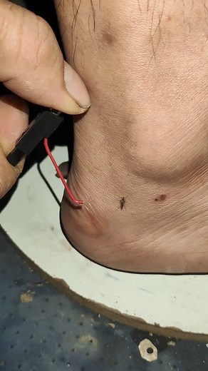 The mosquito's saliva is transferred to the host during the bite, and can cause an itchy rash #mosquito #mosquitoes #mosquitobites #mosquitorepellent #mosquitokiller #mosquitos #mosquitocontrol | Lexus Pet Boutique