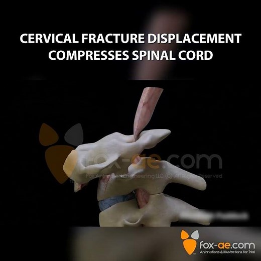 Cervical Fracture Compresses Spinal Cord